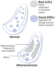 Illustration: LDL Atherosklerose