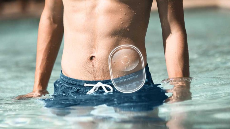 Dive Straight In – With Skin-Compatible Silicone Gels for Stoma